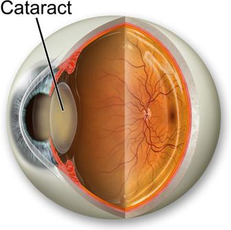 Diagram of Cataracts