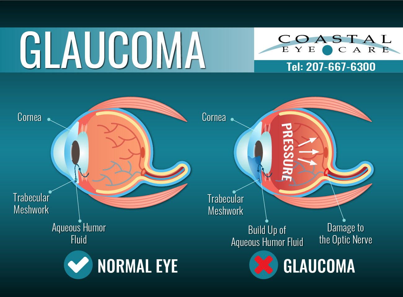 glaucoma illustration - treatment at Coastal Eye Care - Ellsworth Maine